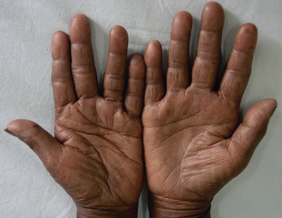Reduction in pigmentation after five weeks.